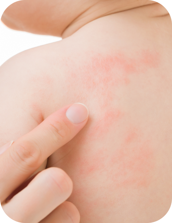 urticaria